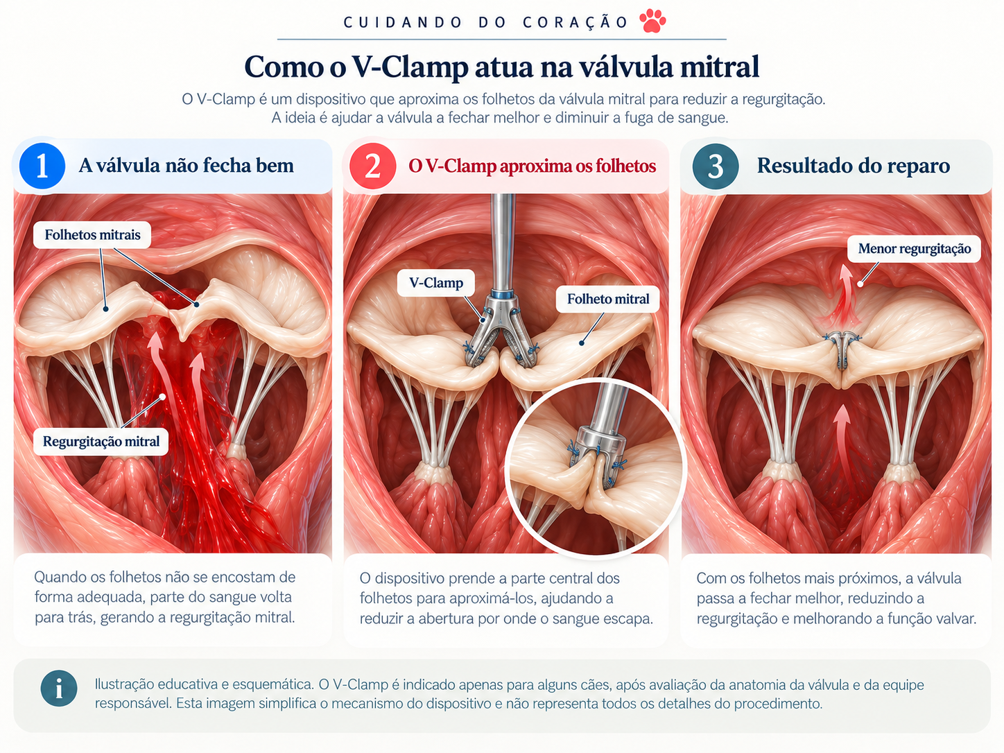 Como o V-Clamp atua na válvula mitral: a válvula não fecha bem, o V-Clamp aproxima os folhetos e o resultado do reparo